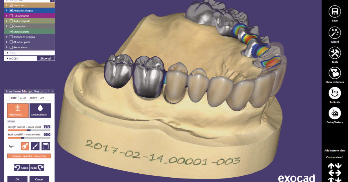Screen shot - ExoCAD dental model