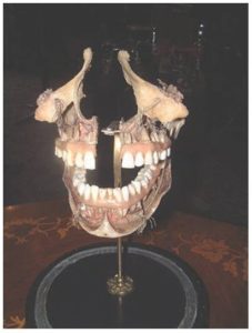 History of dentistry. Dental Specimen - late 19th century - human jaw, with teeth and nerves, in a glass dome. Purchased from Ash in 1909 for £3 - 6 - 0d. (Part of the Beamish museum collection).