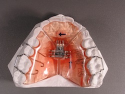 Photo - 3-way expander (source: Olympic Orthodontic Lab)
