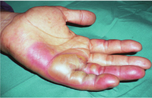 Photo - hand injured by radiation